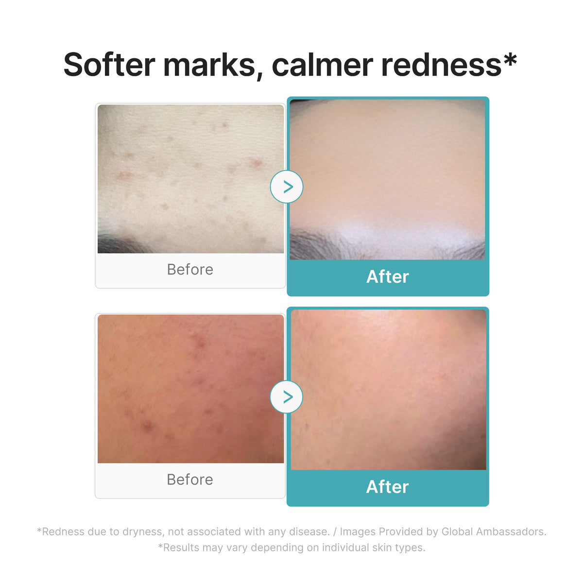[Exclusive Deal] Amazon’s #1 Beauty Brand | Azelaic Acid 16 Calming Serum